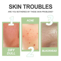SdatterFruit Acid Facial Exfoliating Gel Deep Clean Pore Blackhead Remove Acne Repair Face Peeling Whiten Moisturizer Skin Care