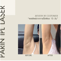 SET PARIN IPL LASER & MINI HIFU : เลเซอร์กำจัดขน & เครื่องนวดหน้ายกกระชับไฮฟู่ เครื่องเลเซอร์กำจัดขน