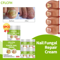 Fungal Nail Repair Cream Toe Fungus Treatment Gel Paronychia Onychomycosis Removal Anti Infection Nail Correction Foot Care