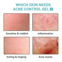 Sdatter 7DAYS Acne repair gel fades acne marks Removes Scar spots Cream Shrink Pore moisturizes brightens Treatment Facial skin