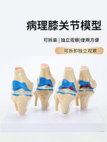病變膝關節模型 骨科教學展示膝蓋 骨質曾生 病理膝關節骨骼模型