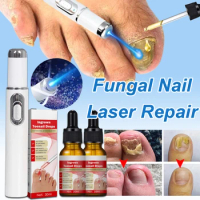 Laser Repair Nail Fungus Paronychia Onychomycosis Ingrown Toenail Anti-Infection Repair Toenail Removes Fungal Nail
