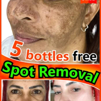 Dark Spot Remover For Face Sun Melasma Freckles Pigment Age Spots Removal Serum Skin Care