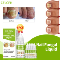 Fungal Nail Treatment Liquid Nail Onychomycosis Repair Paronychia Anti Infection Solution Toe Fungus Removal Foot Cleaner