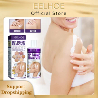 EELHOE Chicken Skin Repair Cream Curing Keratosis Pilaris Skin Treatment Body Lotion Deep Moisturizing Softening Whitening Cream