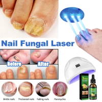 Fungal Nail Laser Device Repair Fast Nails Fungus Anti Infection Paronychia Onychomycosis Ingrown Toenail Foot Care Device