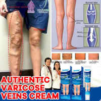 Varicose Veins Cream Obat Varises Salep Penghilang Varises Vaskulitis Varicose Veins Obat Varises Sa
