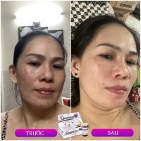 Combo 2h gluthanion và 1h vitamin e đỏ oskin hỗ trợ cân bằng nội tiết tố , mờ nám , giúp da trắng sá