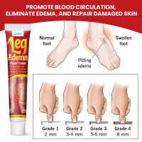 Krim urutan edema pengecut edema bengkak kaki betis pelancar peredaran darah LEG EDEMA CREAM penjag