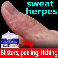 krim gatal kulit eczema cream Psoriasis Cream Effective Itching Sweat Herpes Treatment Ointment Itch