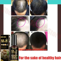 For men and women's hair.Anti hair loss spray anti hair loss hair nutrition growth agent essence promotes hair growth.
