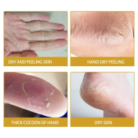 Sdottor Cracked skin banana Removal repair cream foot repair maintenance anti-freeze cracking dry Moisturizing Treatment hand fe