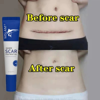 7-Day Recovery Scar Cream Fast Removal Skin Scars Treat Surgery Scars Stretch Marks Acne Pox Prints Burn Repair Facial Care Gel