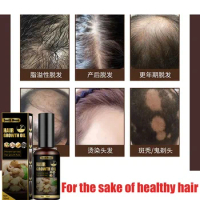 Take good care of your hair.Anti hair loss spray anti hair loss hair nutrition growth agent essence promotes hair growth.