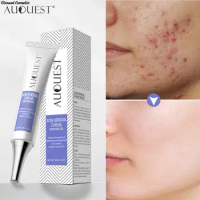 Herbal Acne Treatment Cream Pimple Spot Removal for Teens Oil Control Acne Scar Gel Shrink Pores Skin Care Beauty Health