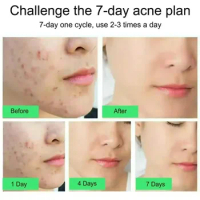 Salicylic Acid Acne Removal Cream Repair Pimple Spots Deep Cleaning Pore Shrinking Oil Control Whitening Moisturizing Skin Care