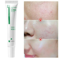 Salicylic Acid Shrink Pores Face Cream Acne Treatment Blackheads Firm Cosmetics Oil Control Moisturizing Remove Whit Pre-Make-up