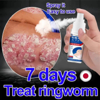 Psoriasis spray ubat kurap ubat gatal kulit Treat psoriasis/eczema/ringworm/fungal infections Ubat k
