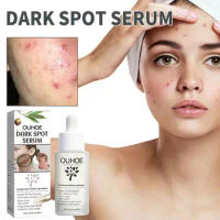 Dark Spot Facial Serum Acne Treatment Pore Shrinking Fade Pigment Improves Dull Skin Brightening Korean Skin Care 30ml