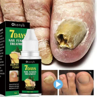 Extra Strong Nail Fungus Treatment Serum Essence oil Feet Nails Repair Care Essence Cream Anti Infection Toe Fungal Removal