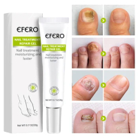20g Fungal Nail Treatment Oil Foot Repair Essence Toe Nail Fungus Removal Gel Anti Infection Cream Fungal Nail Removal