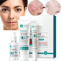 Acne Treatment Face Cream Tea Tree Serum Effectively Beat Acne-prone Skin Repairing Acne Spot Treatment Blackheads Acne Scar
