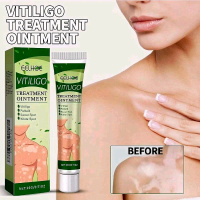 Salep Penghilang Vitiligo Salep Krim Vitiligo Bintik Putih Salep vitiligo Obat vitiligo Merawat dan 