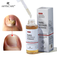 ARTISCARE Nail Fungal Essence Feet Care Nail Fungus Serum Infection Onychomycosis beauty health cosmetics
