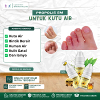 Propolis SM Solusi Untuk Mengatasi Kutu air Di Jari Tangan Dan Kaki, Salep Bintik Berair Gatal, Gata