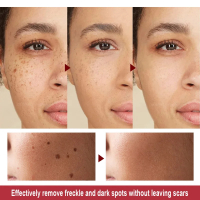 Plasma Pen Warts Black Dots Remover Skin Tag Remover Wart Eliminator Electric Mole Freckles Papillom