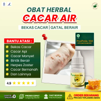 Obat Cacar Air, Bekas Cacar, Cacar Bernanah, Cacar Api, Campak, Gatal Cacar, Herpes Zoster, Cacar Ap