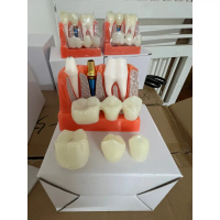Mẫu hàm tư vấn implant- cầu răng dùng trong nha khoa