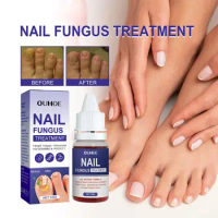 Fungus Nails Treatment For Fingernails Toenails Repair Onychomycosis Paronychia Anti Infection Toe Nail Fungal Removal Liqu I7D6