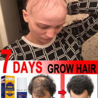 Rapid hair growth spray to repair baldness