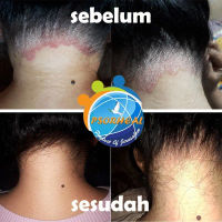 Cream Obat Salep Ketombe Parah Psoriasis SCALP PSORHEAL ISRAEL #malam
