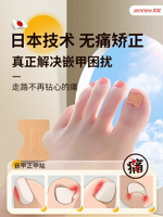甲溝矯正器日本正甲貼嵌甲腳指甲糾正器專用貼腳趾正甲片甲溝墊炎