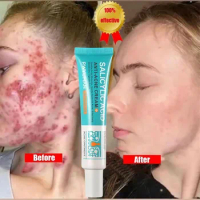 Salicylic Acid Acne Treatment Face Cream Anti Pimples Spots Acne Removal Gel Repairing Scars Pores Shrink Oil Control Skin Care