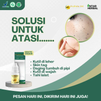 Propolis SM Kutil, Penghilang Kutil, Kutil Di Leher, Kutil Di Wajah, Skin Tag, Daging Jadi Menahun,