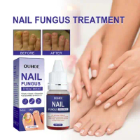 1PCS Nail Fungal Treatment Feet Care Essence Anti Infection Fungal Repair Onychomycosis Nail Fungus Serum Paronychia Remova B9J4