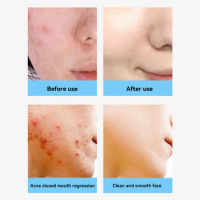 Anti-acne Treatment Cream Salicylic Acid Acne Deep Cleaning Pore Repair Pimple Spots Shrinking Oil Control Moisturizer Skin Care