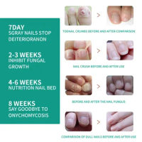 Sdottor Fungal Nail Gel Treatment Feet Care cream Anti Infection Paronychia Onychomycosis Repair Foot Toe Nails Fungus Removal O