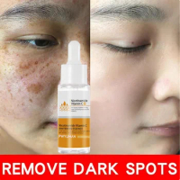 Niacinamide Dark Spot Removal Serum Powerful Whitening Fade Melasma Freckles Melanin Pigment Correction Lighten Brighten Serum