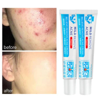 Repair Pimple Spots Salicylic Acid Treatment Acne Cream Deep Cleaning Pore Shrinking Anti-acne Oil Control Moisturizer Skin Care