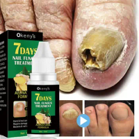 Nail Fungus Treatment Serum Toe Fungal Repair Products Hand Foot Care Removal Gel Anti Infection Onychomycosis Paronychia