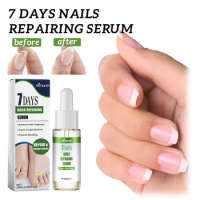 7DAYS Nail Fungus Treatment Liquid Serum Anti-Infection Onychomycosis Paronychia Hand Care Nails Foot Fungal Removal Gel 20ml