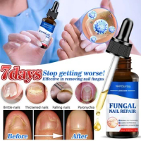 Fungal Nail Treatment Oil Foot Repair Essence Toe Nail Fungus Removal Gel Anti Infection Cream Fungal Nail Removal 10ML