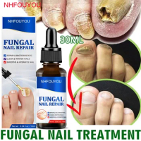 Nail Fungus Treatment Oil Foot Repair Essence Toe Nail Fungus Removal Gel Anti Infection Cream Fungal Nail Removal 10ML