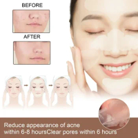 Sdottor Salicylic acid acne patch Treatment closed acne Removal Pimple Scar Spot repair face Cream Shrink Pore Facial Beauty Ski