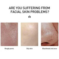 15ml Salicylic Acid Acne Cream Liquid For Face Black Dots Acne Pimple Mark Remedy Removal Moisturizing Skin Care Cream U2H2