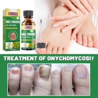 Onychomycosis repair solution toenail tea tree oil finger thick soft nail Treat fungal Anti Infection hand foot nails care Serum